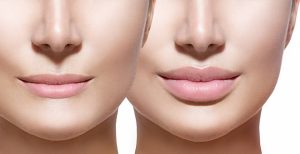 Filler acido ialuronico Milano