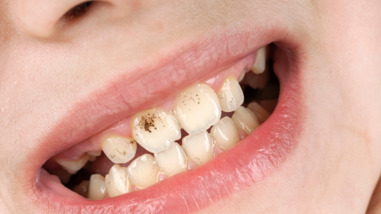 Ritiro gengivale Genova