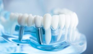 Informazioni per Impianti Dentali Milano