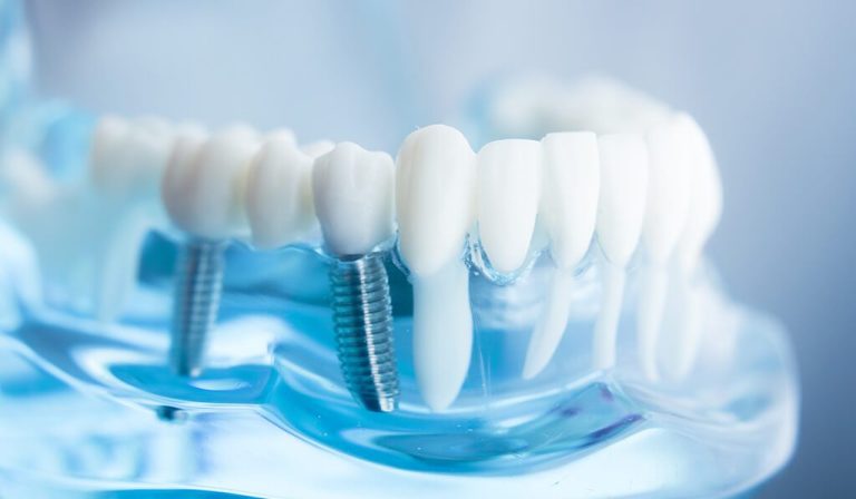 Informazioni per Impianti Dentali Milano Informazioni per Impianti Dentali Milano